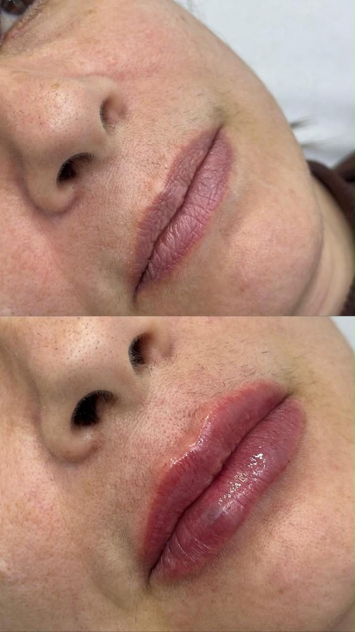 Vídeo: Preenchimento Labial e Facial